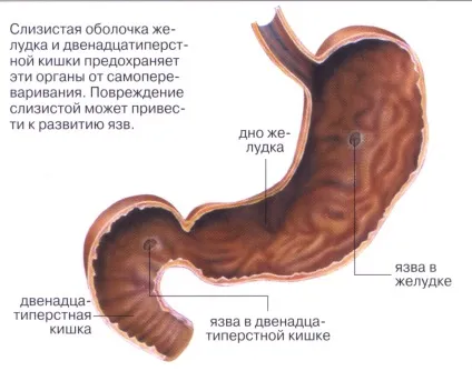 Кровотеча при виразці шлунка що робити (виразці) Кровотеча при виразці шлунка що робити