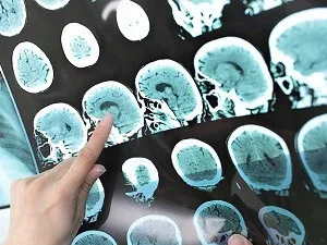 Чи можна вживати алкоголь при розсіяному склерозі (можна) Чи можна вживати алкоголь при розсіяному склерозі