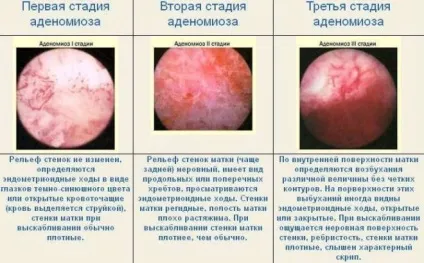 Чи можна завагітніти при ендометріозі (питання можна завагітніти) Чи можна завагітніти при ендометріозі