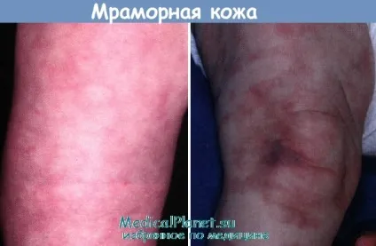 Мармурова шкіра - причини, діагностика, лікування (причини мармурової шкіри) Мармурова шкіра - причини, діагностика, лікування