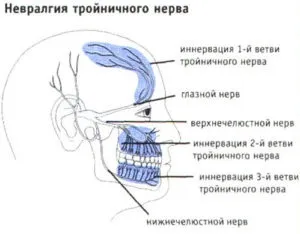 Невропатія трійчастого нерва, причини і лікування (трійчастого) Невропатія трійчастого нерва, причини і лікування