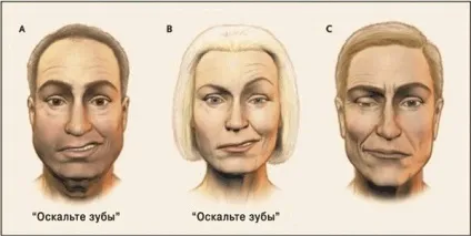 Нейропатія лицевого нерва, симптоми і лікування трійчастого нерва, МКБ-10