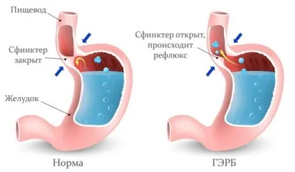 Неприємний присмак у роті види, що означає, причини, як прибрати (присмак) Неприємний присмак у роті види, що означає, причини, як прибрати