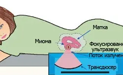 Операція при міомі матки підготовка і наслідки (матки) Операція при міомі матки підготовка і наслідки