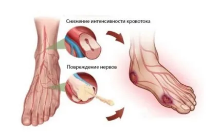 Оніміння ноги від коліна до стопи - причини і лікування (оніміння) Оніміння ноги від коліна до стопи - причини і лікування