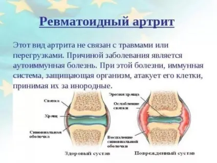 Оніміння ноги від коліна до стопи - причини і лікування (коліна) Оніміння ноги від коліна до стопи - причини і лікування