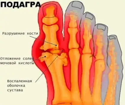 Оніміння ноги від коліна до стопи - причини і лікування (коліно) Оніміння ноги від коліна до стопи - причини і лікування