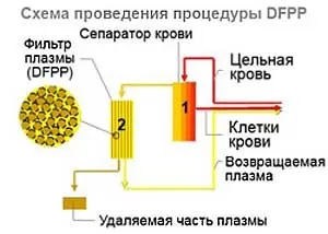 Відділення гравітаційної хірургії крові - каскадний плазмофільтрація крові (каскадної фільтрації плазми) Відділення гравітаційної хірургії крові - каскадний плазмофільтрація крові