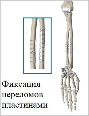 Відкритий перелом кісток передпліччя