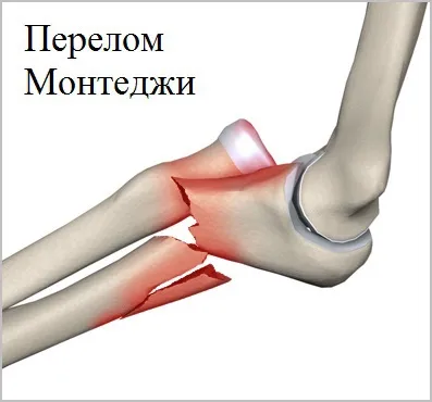 Відкритий перелом кісток передпліччя