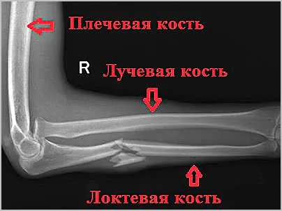Відкритий перелом кісток передпліччя