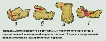 Перелом п'яткової кістки, скільки заживає п'ята, ортез, як довго (заживає) Перелом п'яткової кістки, скільки заживає п'ята, ортез, як довго