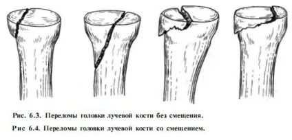 Перелом головки променевої кістки симптоми, причини і лікування (перелом) Перелом головки променевої кістки симптоми, причини і лікування