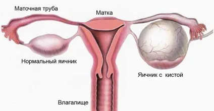 Патології жовтого тіла недостатність, персистенція і розрив кісти (патології) Патології жовтого тіла недостатність, персистенція і розрив кісти