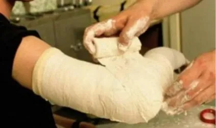 Перелом головки променевої кістки ліктьового суглоба симптоми, лікування і відновлення ліктя з (головки) Перелом головки променевої кістки ліктьового суглоба симптоми, лікування і відновлення ліктя зі