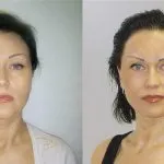 Лазерна біоревіталізація шкіри переваги, як проходить процедура (фото до і після) (шкіри) Лазерна біоревіталізація шкіри переваги, як проходить процедура (фото до і після)
