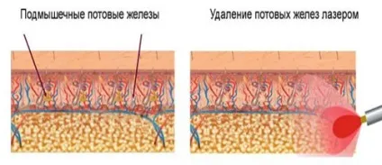 Лазерне лікування гіпергідрозу показання до процедури і ускладнення (лазерне лікування гіпергідрозу) Лазерне лікування гіпергідрозу показання до процедури і ускладнення