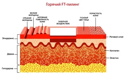 Лазерний пілінг обличчя переваги, різновиди, підготовка, протипоказання