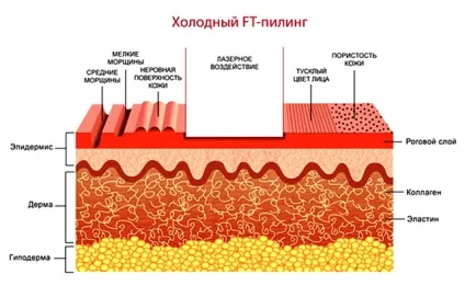 Лазерний пілінг обличчя переваги, різновиди, підготовка, протипоказання