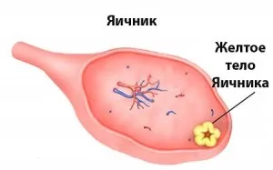 Персистенція жовтого тіла в правому або лівому яєчнику (тіла) Персистенція жовтого тіла в правому або лівому яєчнику