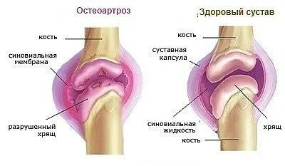 Чому болять суглоби рук і ніг одночасно, від чого з'являється хрускіт в них (чому) Чому болять суглоби рук і ніг одночасно, від чого з'являється хрускіт в них