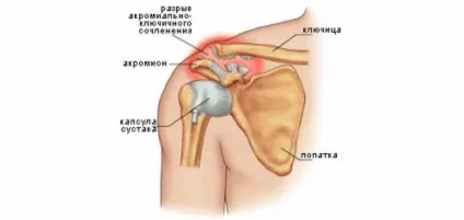 Підвивих плечового суглоба, симптоми підвивиху плеча
