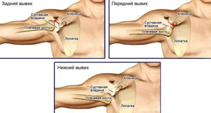 Підвивих плечового суглоба, симптоми підвивиху плеча