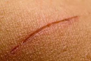Порізи на ногах лезом, сухожилля, глибокий, що буде, як можна лікувати (сухожилля) Порізи на ногах лезом, сухожилля, глибокий, що буде, як можна лікувати