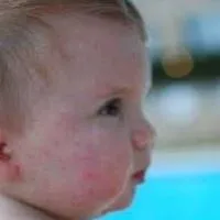 З'явилася пітниця у дитини