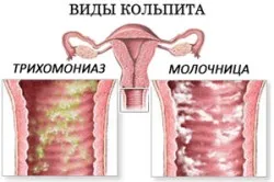Причини появи виділень зеленуватого кольору без запаху (виділень) Причини появи виділень зеленуватого кольору без запаху
