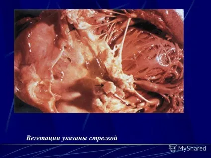 Презентація на тему інфекційний ендокардит (ОСНОВНІ Клінічні прояви) Презентація на тему інфекційний ендокардит