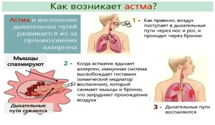 Приступ задухи при бронхіальній астмі (у дітей і дорослих) ознаки, діагноз і перша допомога (дітей) Приступ задухи при бронхіальній астмі (у дітей і дорослих) ознаки, діагноз і перша допомога