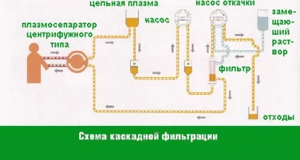 Процедура каскадна фільтрація плазми при високому холестерин (плазми) Процедура каскадна фільтрація плазми при високому холестерин