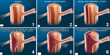Аневризма аорти симптоми, причини, лікування, діагностика, невідкладна допомога (расслаивающая) Аневризма аорти симптоми, причини, лікування, діагностика, невідкладна допомога