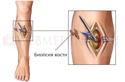 Рак кісток симптоми і прояв, види, причини і лікування (симптоми) Рак кісток симптоми і прояв, види, причини і лікування