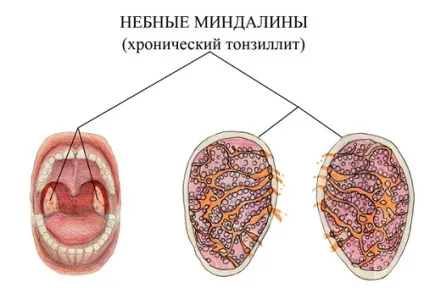 Дитина хропе уві сні що може викликати подібне явище (хропе) Дитина хропе уві сні що може викликати подібне явище