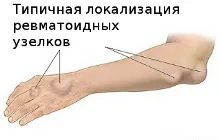 ревматоїдні вузлики