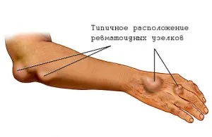 Ревматизм - причини, симптоми і народні засоби лікування ревматизму (кошти) Ревматизм - причини, симптоми і народні засоби лікування ревматизму