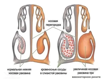 Риніт гнійний причини, різновиди і лікування (різновиди) Риніт гнійний причини, різновиди і лікування