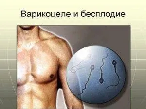 Лікування варикоцеле у чоловіків, як лікувати і методи лікування варикоцеле яєчка (вилікувати) Лікування варикоцеле у чоловіків, як лікувати і методи лікування варикоцеле яєчка