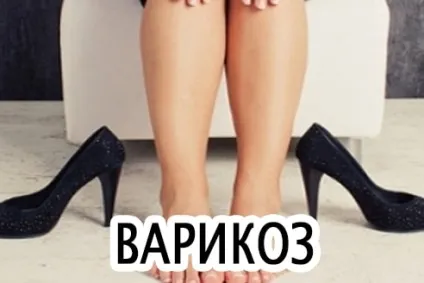 Лікування варикозу медом медовий масскаж при варікохном розширенні вен на ногах, лікування варикозу (варикозу) Лікування варикозу медом медовий масскаж при варікохном розширенні вен на ногах, лікування варикозу