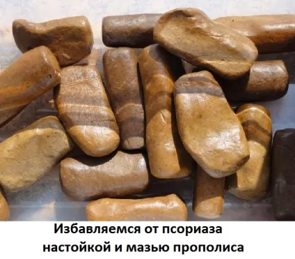 Лікування псоріазу прополісом мазь і настоянка, сайт про методи лікування докторів Неумивакіна, Болотова (лікувальне харчування) Лікування псоріазу прополісом мазь і настоянка, сайт про методи лікування докторів Неумивакіна, Болотова