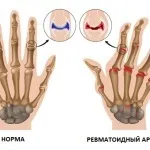 Симптоми ревматоїдного артриту