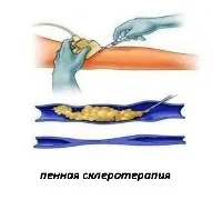 Склеротерапія вен ніг наслідки, результати, відео (результати) Склеротерапія вен ніг наслідки, результати, відео
