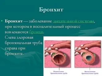 Скільки днів лікується гострий і хронічний бронхіти (хронічний) Скільки днів лікується гострий і хронічний бронхіти