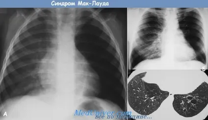Синдром мак-Лауда (macleod) - синоніми, автори, клініка (macleod) Синдром мак-Лауда (macleod) - синоніми, автори, клініка