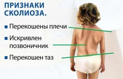 Сколіоз 1 ступеня симптоми, профілактика та лікування (грудного відділу хребта) Сколіоз 1 ступеня симптоми, профілактика та лікування