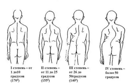 Сколіоз 1 ступеня симптоми, профілактика та лікування (грудного відділу хребта) Сколіоз 1 ступеня симптоми, профілактика та лікування