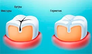 Ступеня карієсу розвиток, ступеня активності і небезпека для людини (мірою) Ступеня карієсу розвиток, ступеня активності і небезпека для людини