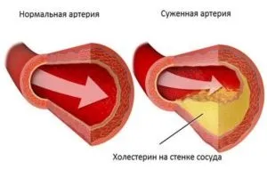 Стенозуючий атеросклероз що це, лікування (стенозуючий) Стенозуючий атеросклероз що це, лікування